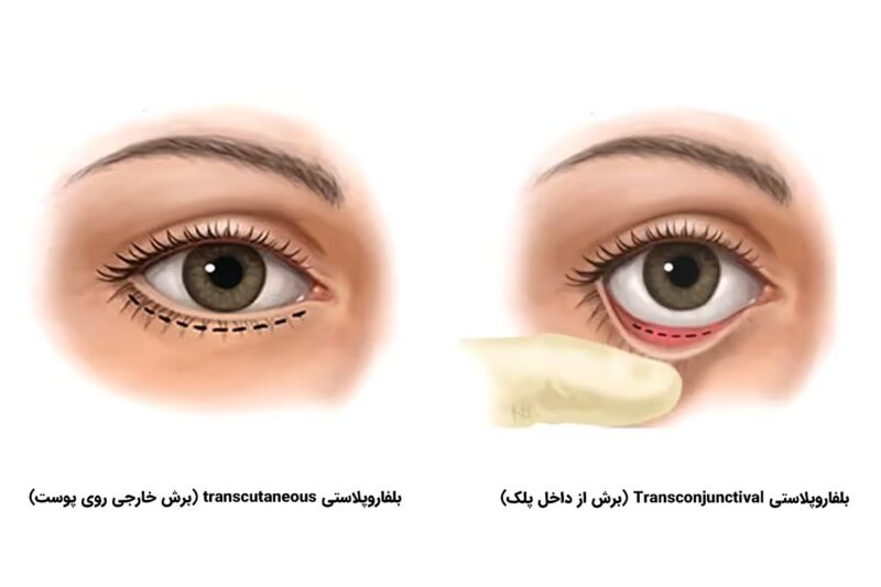 عمل پلک پایین | راهکاری ایمن برای رفع پف، افتادگی و چین‌وچروک اطراف چشم