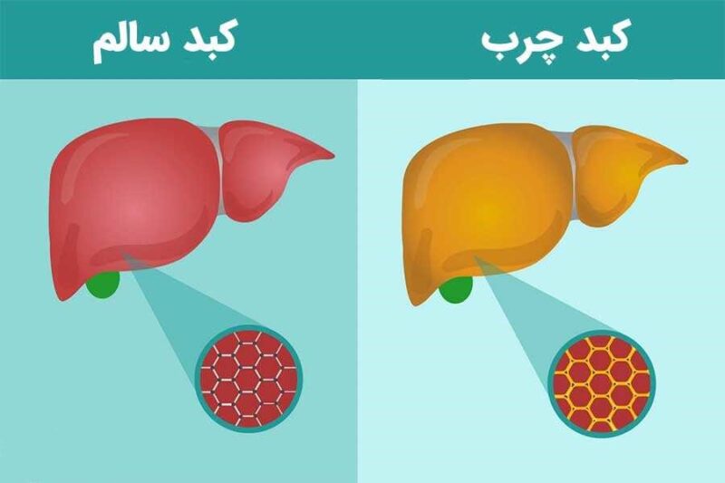 نقش تغذیه در پیشگیری و درمان کبد چرب