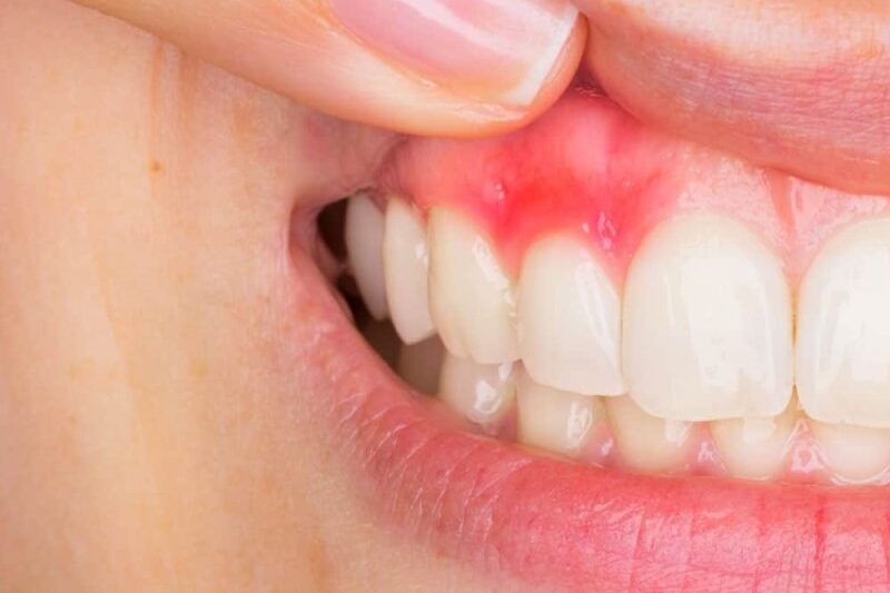 عفونت دندان و مشکلات آن: هر آنچه باید بدانید